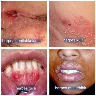 Illustration for article titled bagaimana cara mengobati herpes sampai tuntas